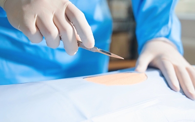 Вшивание ампулы от алкоголизма - Квинмед